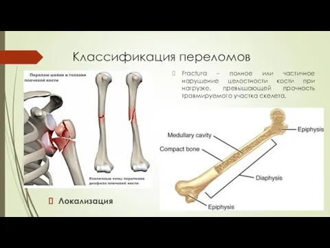 Классификация переломов Локализация Fractura – полное или частичное нарушение целостности кости