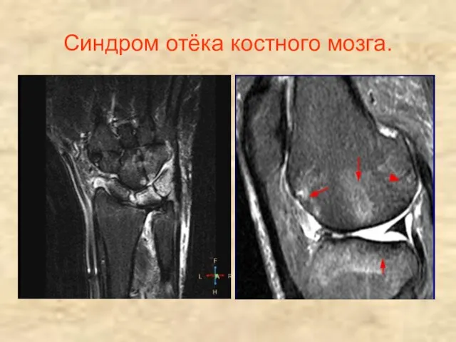 Синдром отёка костного мозга.