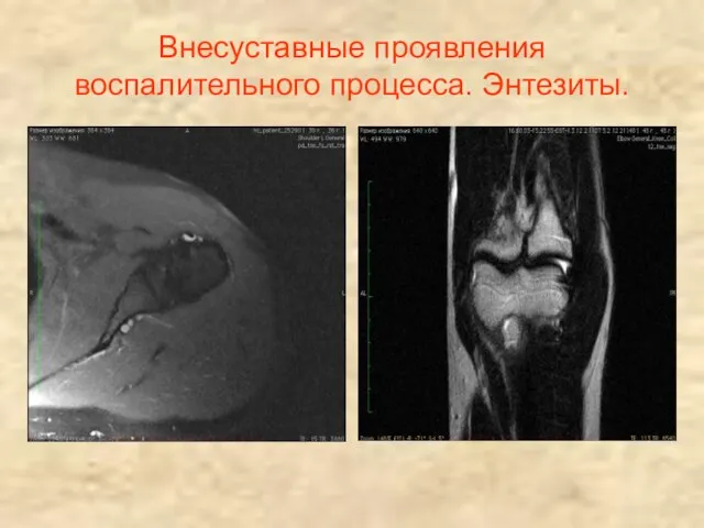 Внесуставные проявления воспалительного процесса. Энтезиты.