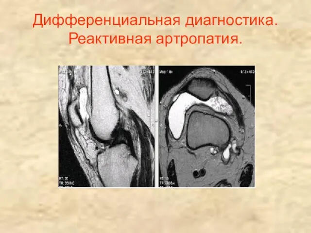 Дифференциальная диагностика. Реактивная артропатия.