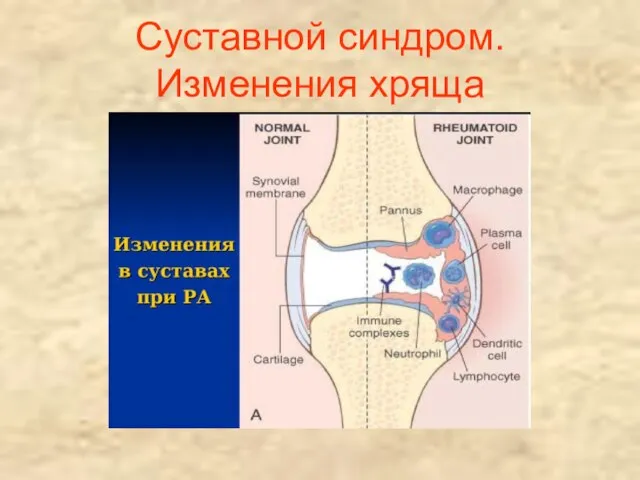 Суставной синдром. Изменения хряща