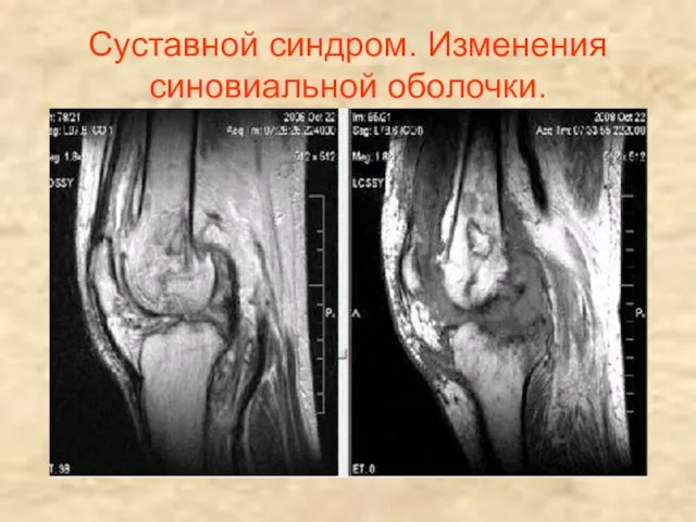 Суставной синдром. Изменения синовиальной оболочки.