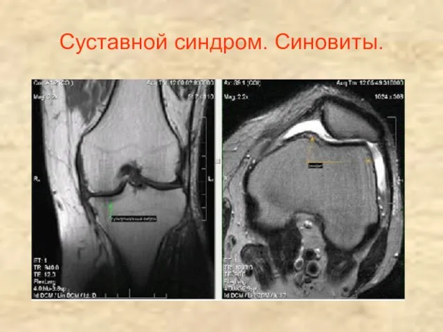 Суставной синдром. Синовиты.