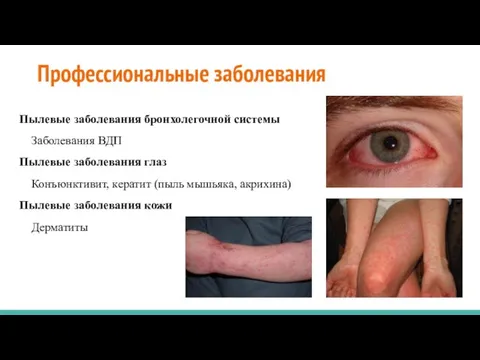 Профессиональные заболевания Пылевые заболевания бронхолегочной системы Заболевания ВДП Пылевые заболевания глаз