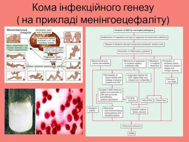 Кома інфекційного генезу ( на прикладі менінгоецефаліту)