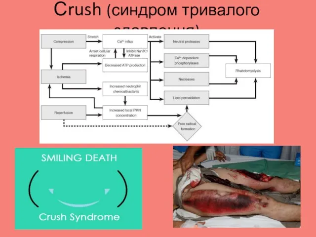 Сrush (синдром тривалого здавлення)