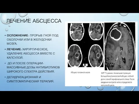 ЛЕЧЕНИЕ АБСЦЕССА ОСЛОЖНЕНИЕ- ПРОРЫВ ГНОЯ ПОД ОБОЛОЧКИ ИЛИ В ЖЕЛУДОЧКИ МОЗГА.