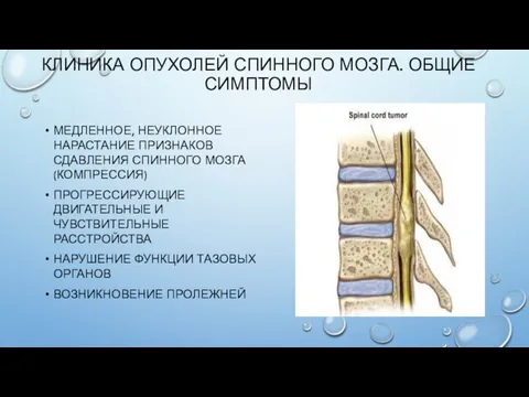 КЛИНИКА ОПУХОЛЕЙ СПИННОГО МОЗГА. ОБЩИЕ СИМПТОМЫ МЕДЛЕННОЕ, НЕУКЛОННОЕ НАРАСТАНИЕ ПРИЗНАКОВ СДАВЛЕНИЯ