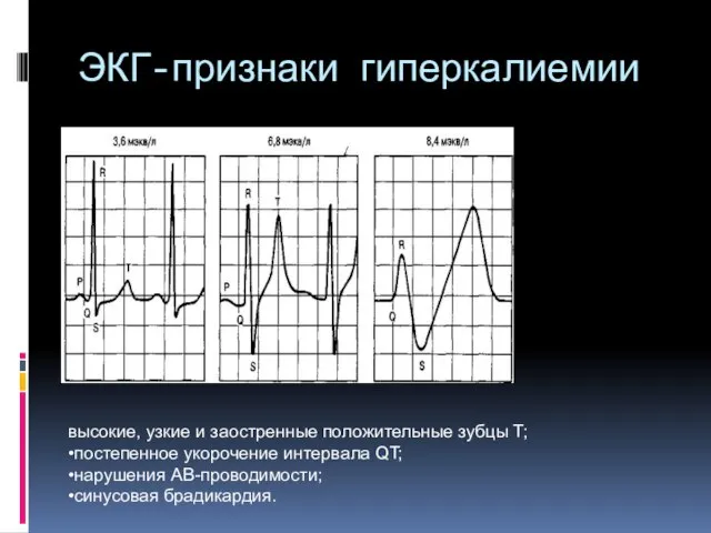 ЭКГ-признаки гиперкалиемии высокие, узкие и заостренные положительные зубцы Т; •постепенное укорочение