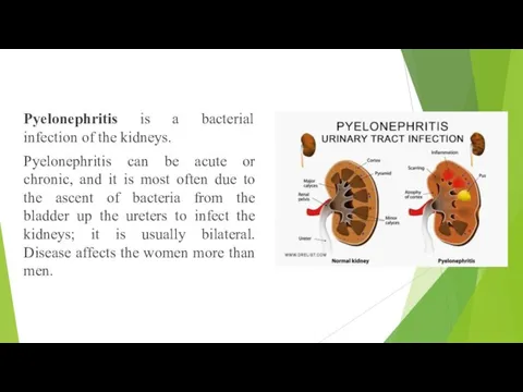 Pyelonephritis is a bacterial infection of the kidneys. Pyelonephritis can be