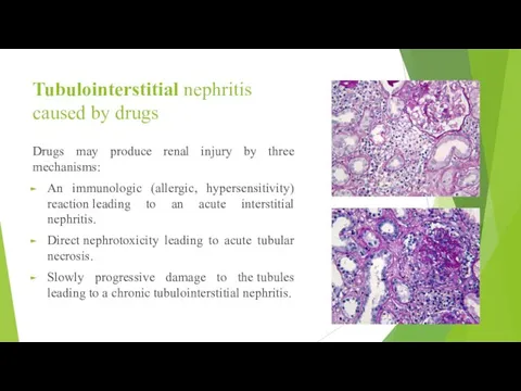 Tubulointerstitial nephritis caused by drugs Drugs may produce renal injury by