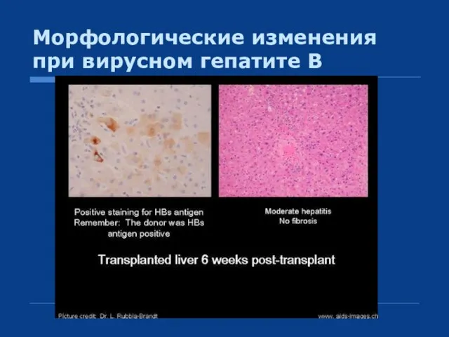 Морфологические изменения при вирусном гепатите В