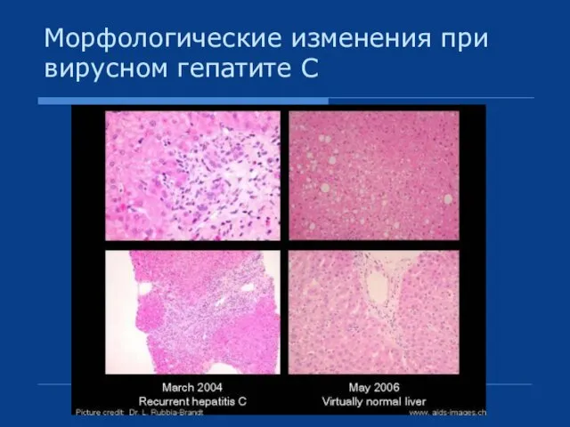 Морфологические изменения при вирусном гепатите С