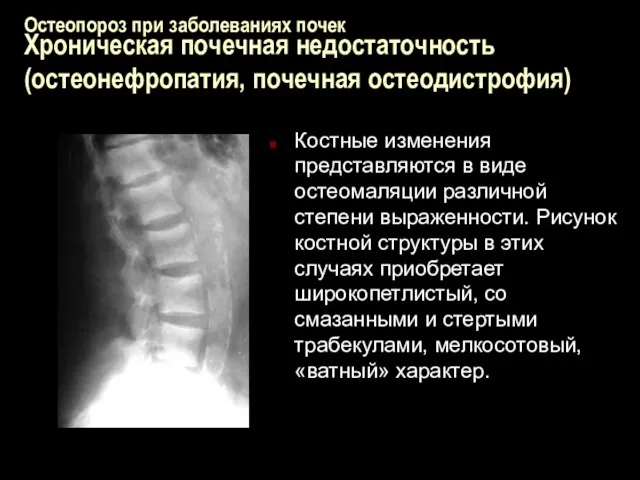 Остеопороз при заболеваниях почек Хроническая почечная недостаточность (остеонефропатия, почечная остеодистрофия) Костные