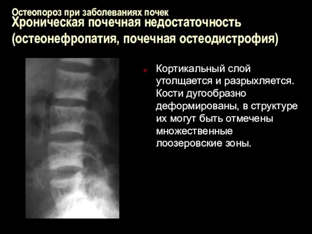 Остеопороз при заболеваниях почек Хроническая почечная недостаточность (остеонефропатия, почечная остеодистрофия) Кортикальный