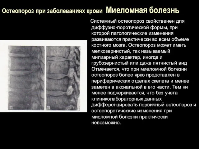 Остеопороз при заболеваниях крови Миеломная болезнь Системный остеопороз свойственен для диффузно-поротической