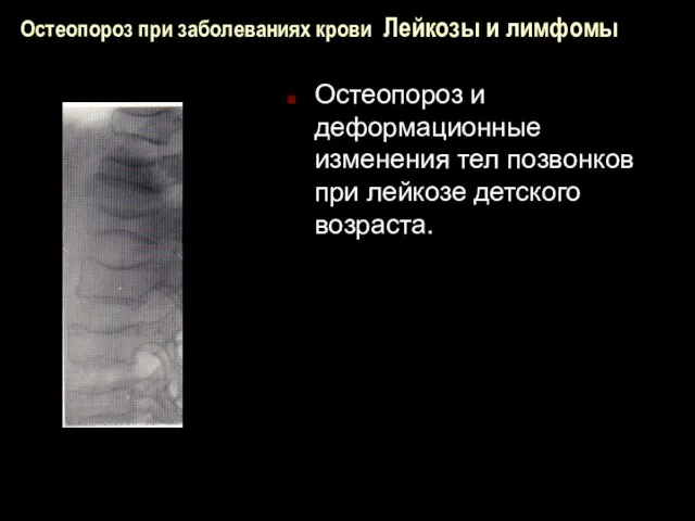 Остеопороз при заболеваниях крови Лейкозы и лимфомы Остеопороз и деформационные изменения