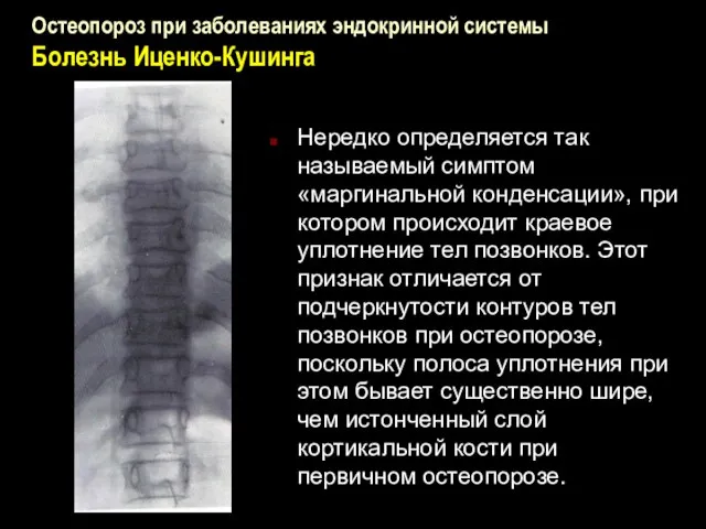 Остеопороз при заболеваниях эндокринной системы Болезнь Иценко-Кушинга Нередко определяется так называемый