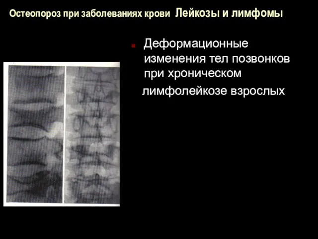 Остеопороз при заболеваниях крови Лейкозы и лимфомы Деформационные изменения тел позвонков при хроническом лимфолейкозе взрослых