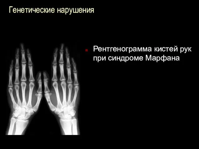 Генетические нарушения Рентгенограмма кистей рук при синдроме Марфана