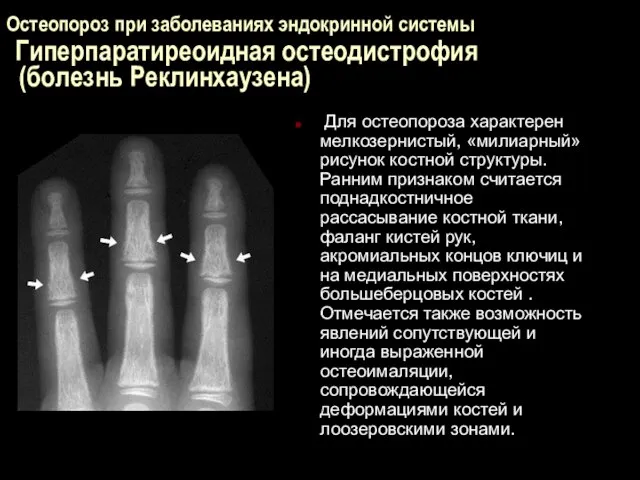 Остеопороз при заболеваниях эндокринной системы Гиперпаратиреоидная остеодистрофия (болезнь Реклинхаузена) Для остеопороза