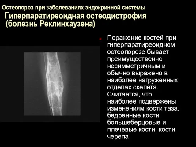 Остеопороз при заболеваниях эндокринной системы Гиперпаратиреоидная остеодистрофия (болезнь Реклинхаузена) Поражение костей