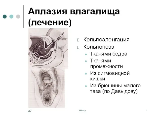 * ВМедА Аплазия влагалища (лечение) Кольпоэлонгация Кольпопоэз Тканями бедра Тканями промежности