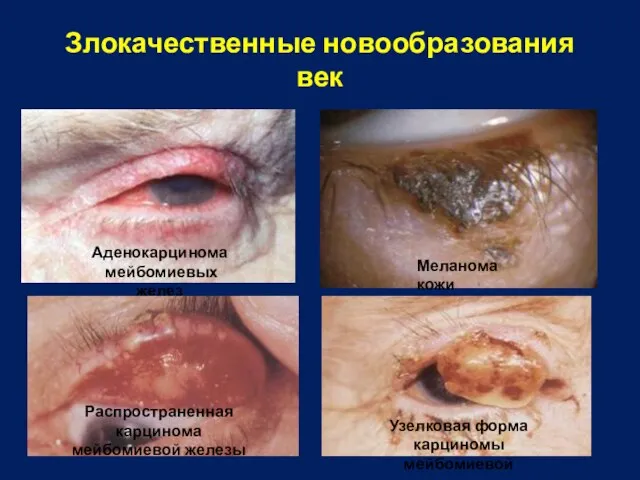 Злокачественные новообразования век Аденокарцинома мейбомиевых желез Меланома кожи Распространенная карцинома мейбомиевой железы Узелковая форма карциномы мейбомиевой