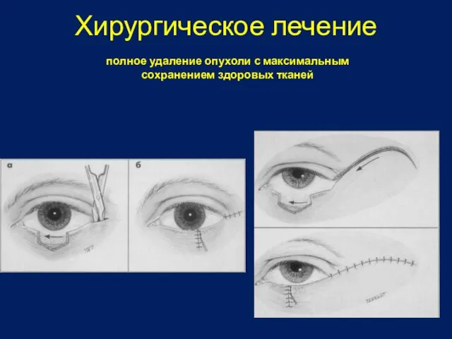 Хирургическое лечение полное удаление опухоли с максимальным сохранением здоровых тканей