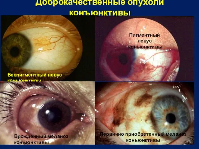 Доброкачественные опухоли конъюнктивы Беспигментный невус коньюнктивы Врожденный меланоз конъюнктивы Первично приобретенный меланоз коньюнктивы Пигментный невус коньюнктивы