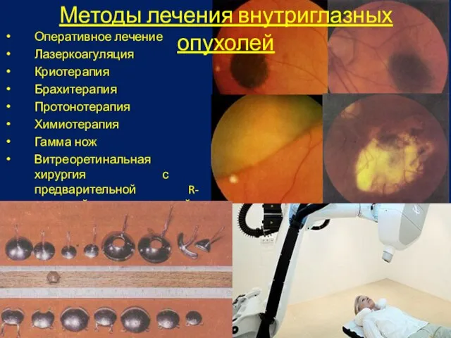 Методы лечения внутриглазных опухолей Оперативное лечение Лазеркоагуляция Криотерапия Брахитерапия Протонотерапия Химиотерапия