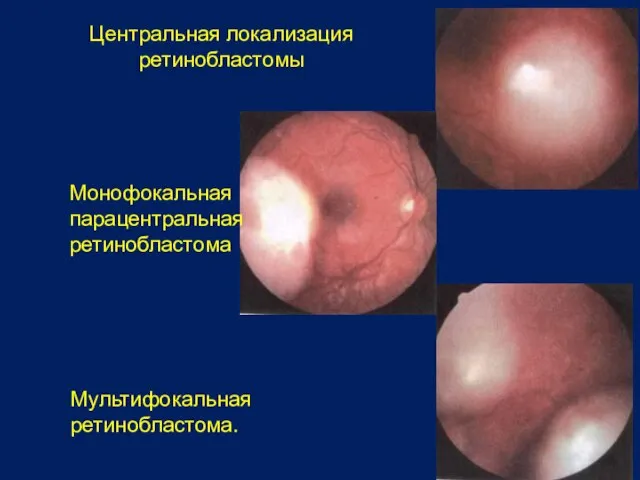 Центральная локализация ретинобластомы Монофокальная парацентральная ретинобластома Мультифокальная ретинобластома.