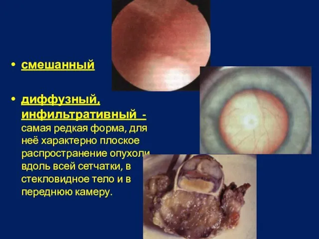 смешанный диффузный, инфильтративный - самая редкая форма, для неё характерно плоское