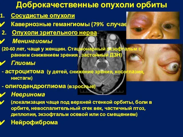 Сосудистые опухоли Кавернозные гемангиомы (79% случаев); 2. Опухоли зрительного нерва Менингиомы