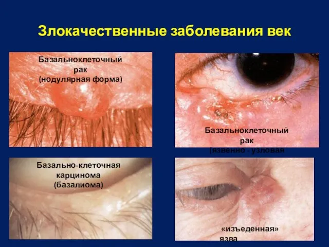 Злокачественные заболевания век Базальноклеточный рак (нодулярная форма) Базальноклеточный рак (язвенно -