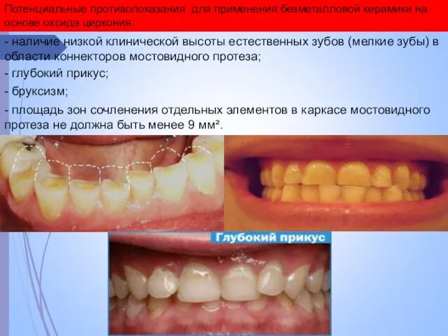 Потенциальные противопоказания для применения безметалловой керамики на основе оксида циркония: -