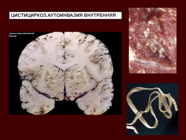 ЦИСТИЦИРКОЗ.АУТОИНВАЗИЯ ВНУТРЕННЯЯ