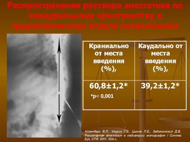 Распространение раствора анестетика по эпидуральному пространству в грудопоясничном отделе позвоночника *р