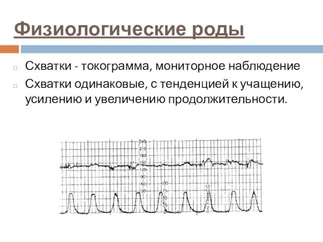 Физиологические роды Схватки - токограмма, мониторное наблюдение Схватки одинаковые, с тенденцией