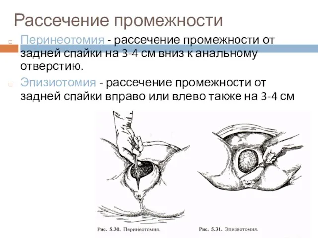 Рассечение промежности Перинеотомия - рассечение промежности от задней спайки на 3-4