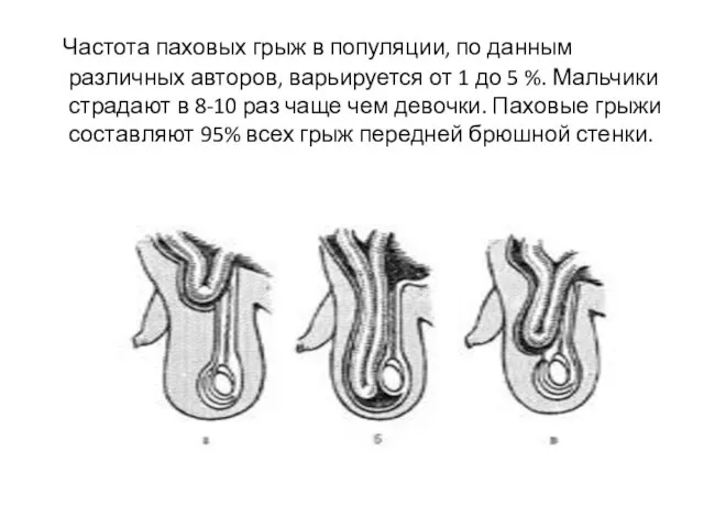 Частота паховых грыж в популяции, по данным различных авторов, варьируется от