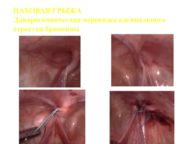 ПАХОВАЯ ГРЫЖА Лапароскопическая перевязка вагинального отростка брюшины