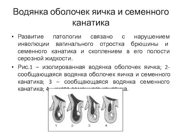 Водянка оболочек яичка и семенного канатика Развитие патологии связано с нарушением