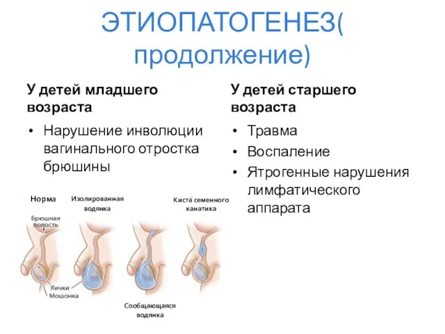 ЭТИОПАТОГЕНЕЗ( продолжение) У детей младшего возраста Нарушение инволюции вагинального отростка брюшины