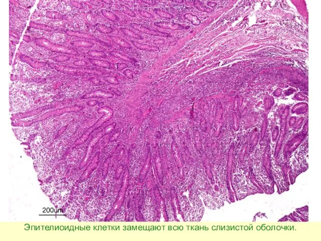 Эпителиоидные клетки замещают всю ткань слизистой оболочки.