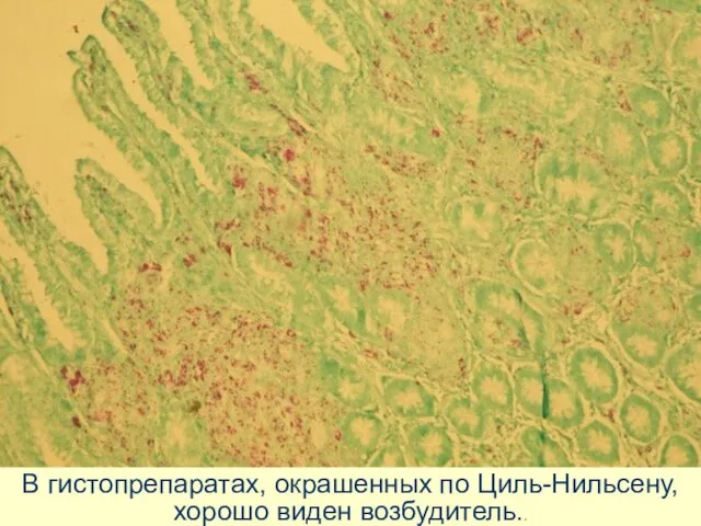 В гистопрепаратах, окрашенных по Циль-Нильсену, хорошо виден возбудитель..