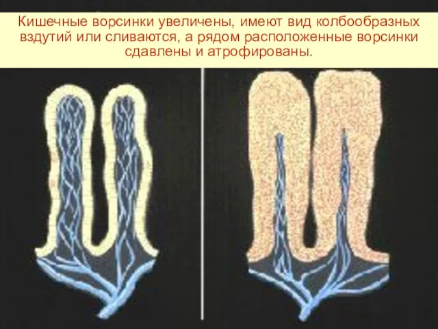 Кишечные ворсинки увеличены, имеют вид колбообразных вздутий или сливаются, а рядом расположенные ворсинки сдавлены и атрофированы.