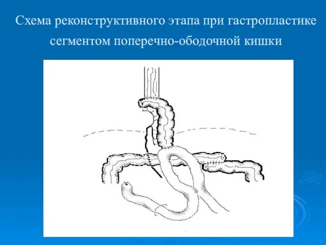 Схема реконструктивного этапа при гастропластике сегментом поперечно-ободочной кишки