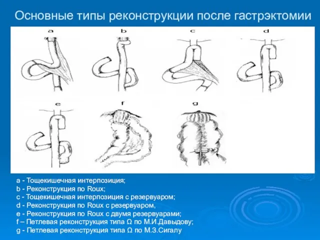 Основные типы реконструкции после гастрэктомии a - Тощекишечная интерпозиция; b -