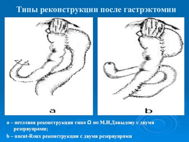 Типы реконструкции после гастрэктомии а – петлевая реконструкция типа Ω по